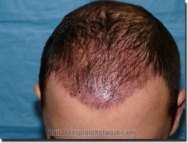 Hair restoration procedure results