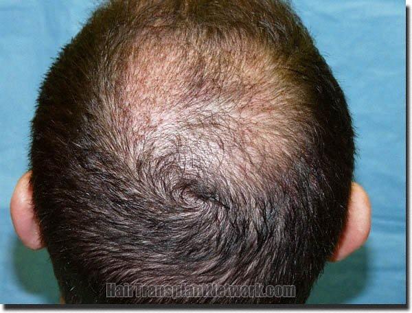 Hair restoration procedure results