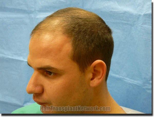 Hair restoration procedure results