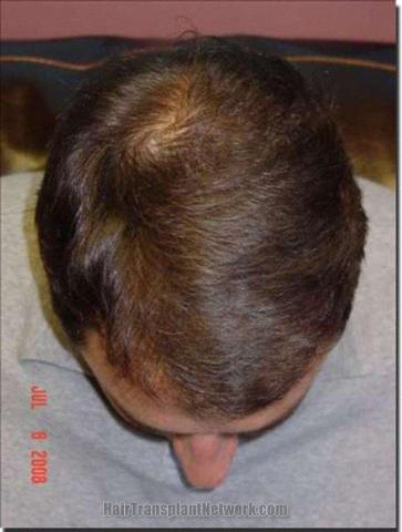 Hair restoration procedure results