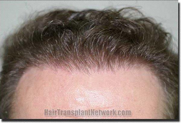 Hair restoration procedure results