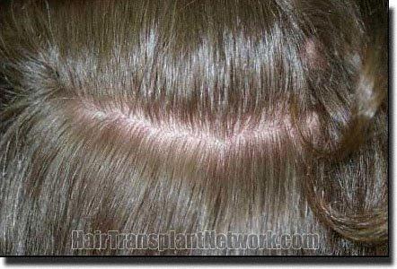 Hair restoration procedure results