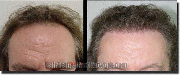 Hair restoration procedure results