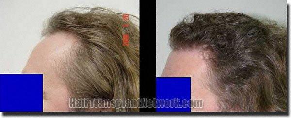 Hair restoration procedure results