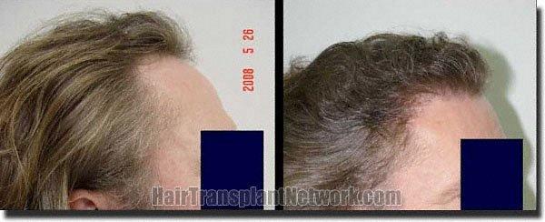 Hair restoration procedure results