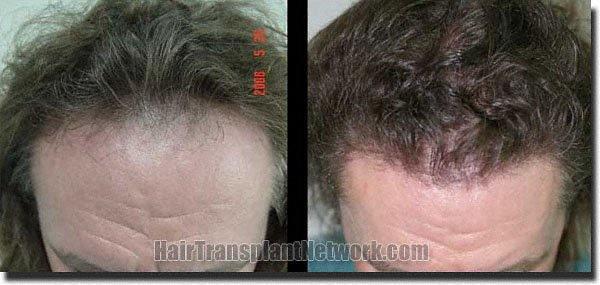 Hair restoration procedure results