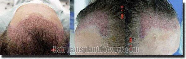 Hair restoration procedure results