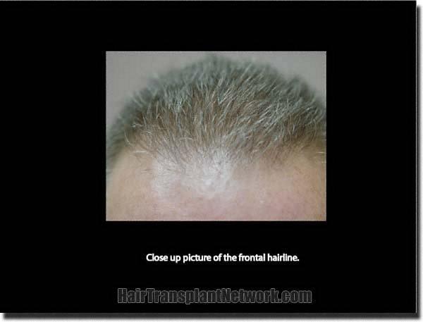 Hair restoration procedure results