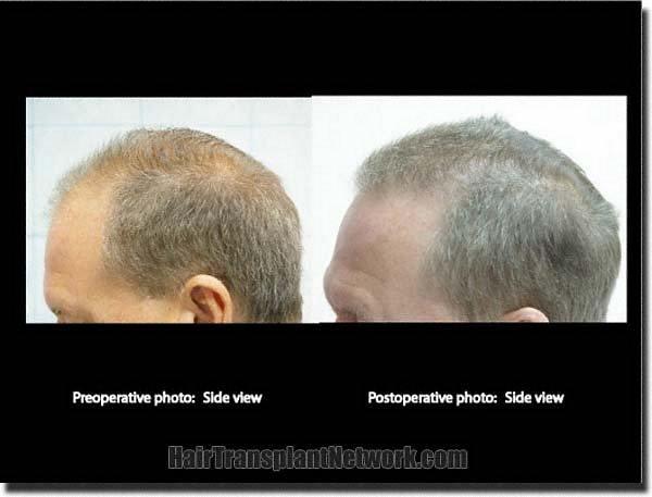 Hair restoration procedure results