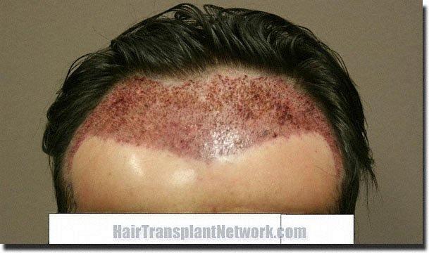 Hair restoration procedure results