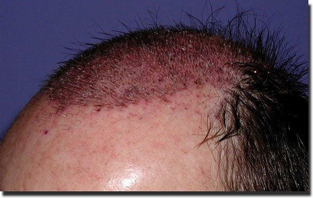 Hair restoration procedure results