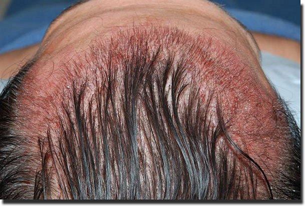 Hair restoration procedure results