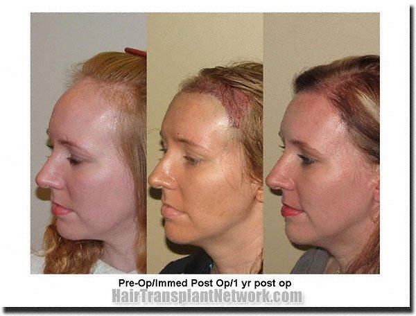 Hair restoration procedure results