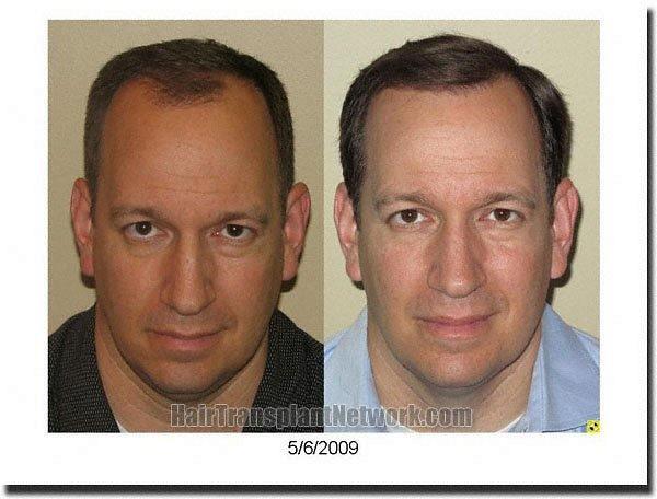 Hair restoration procedure results