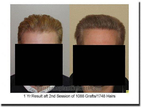 Hair restoration procedure results