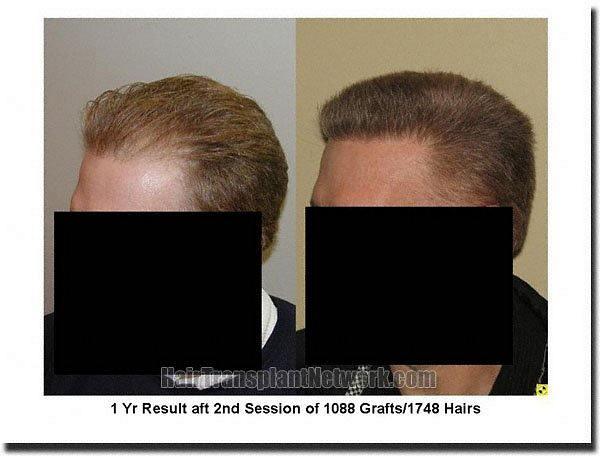 Hair restoration procedure results