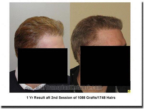 Hair restoration procedure results