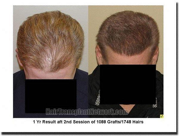 Hair restoration procedure results