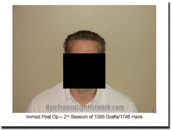 Hair restoration procedure results