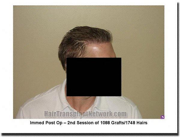 Hair restoration procedure results