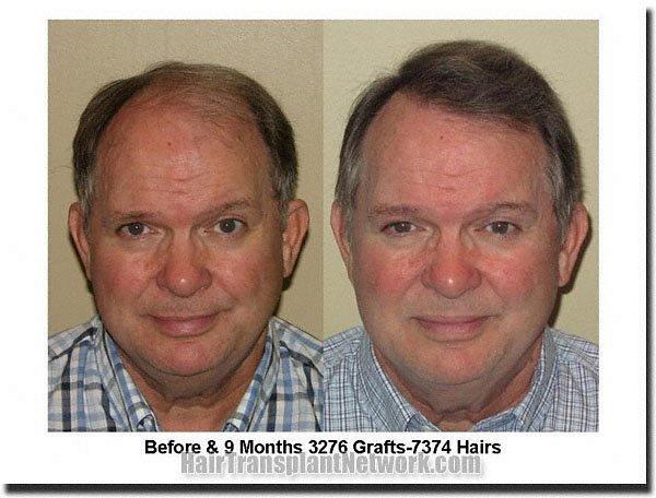 Hair restoration procedure results