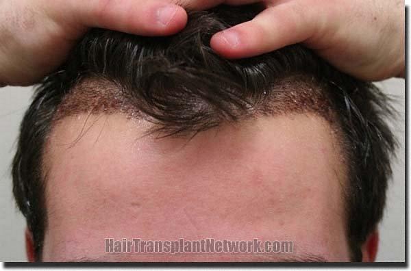 Hair restoration procedure results