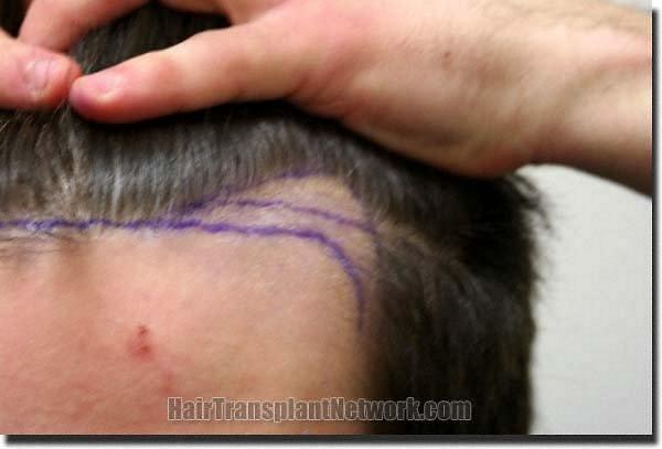 Hair restoration procedure results