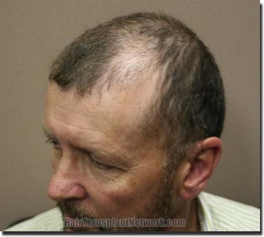 Hair restoration procedure results