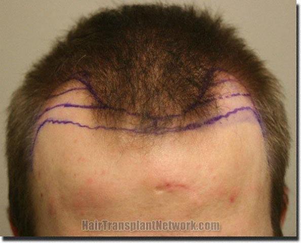 Hair restoration procedure results