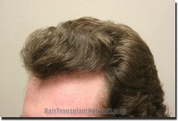 Hair restoration procedure results