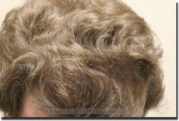 Hair restoration procedure results