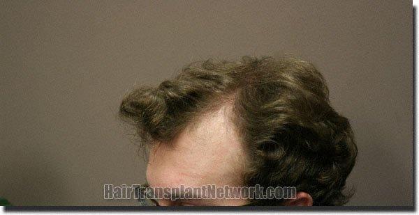 Hair restoration procedure results