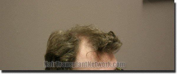 Hair restoration procedure results