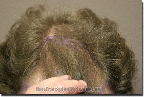 Hair restoration procedure results