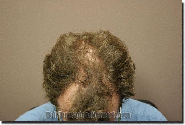 Hair restoration procedure results