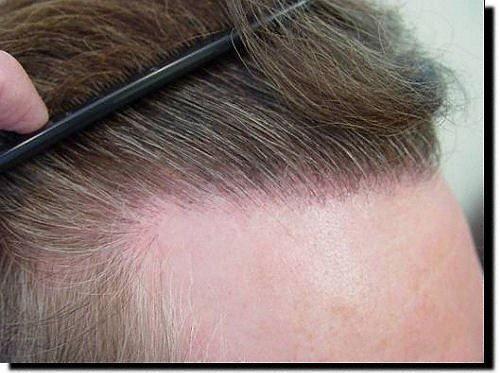 Hair restoration procedure results