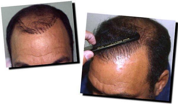 Hair restoration procedure results