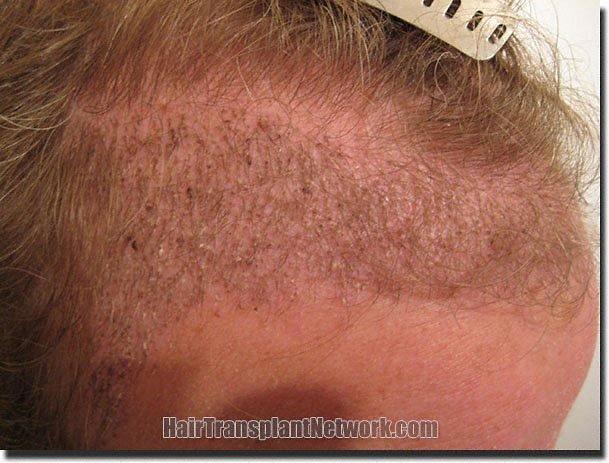 Hair restoration procedure results