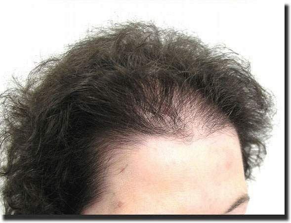 Hair restoration procedure results