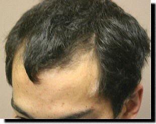 Hair restoration procedure results