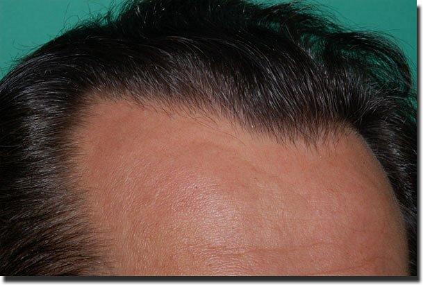 Hair restoration procedure results