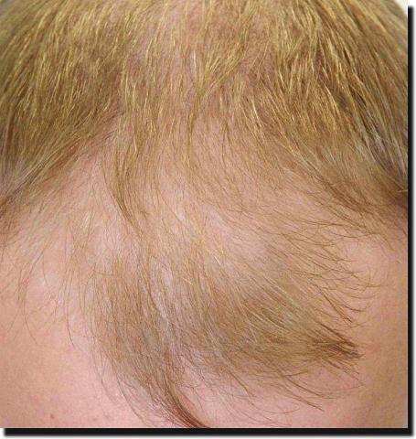 Hair restoration procedure results