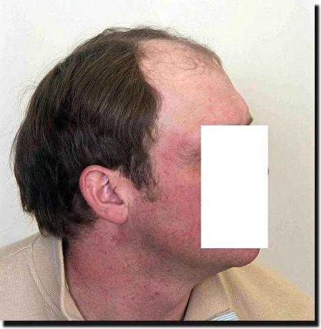 Hair restoration procedure results