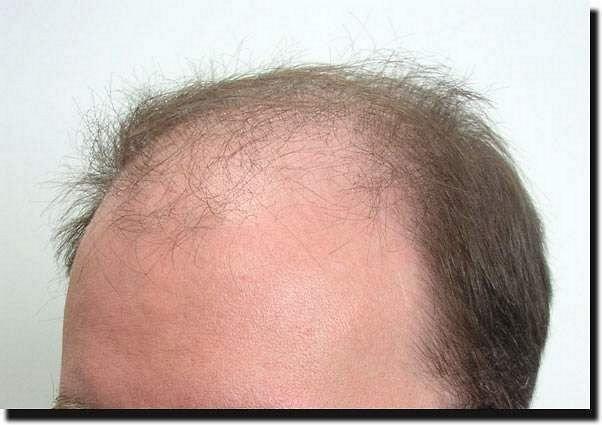 Hair restoration procedure results