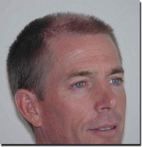 Hair restoration procedure results