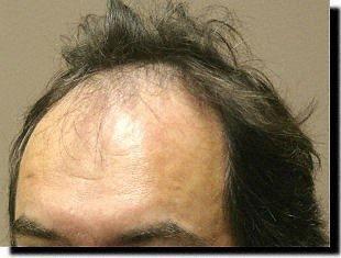 Hair restoration procedure results