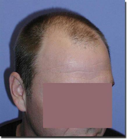 Hair restoration procedure results