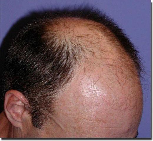 Hair restoration procedure results