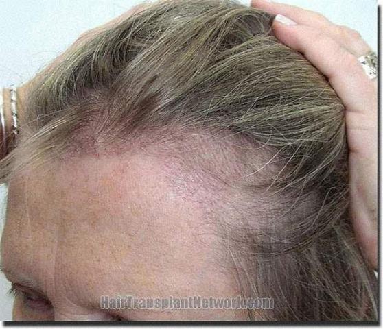 Hair restoration procedure results