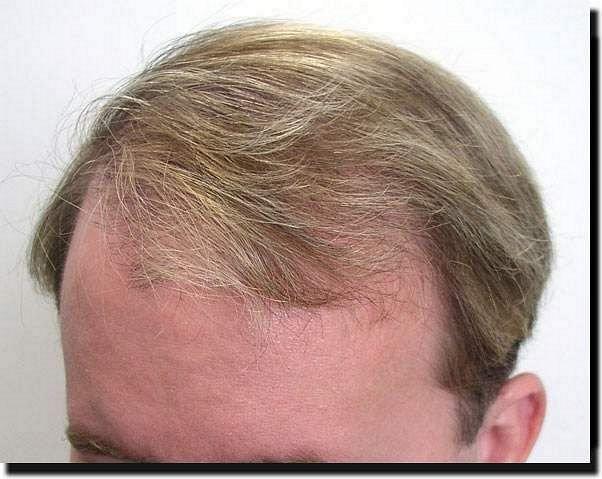 Hair restoration procedure results